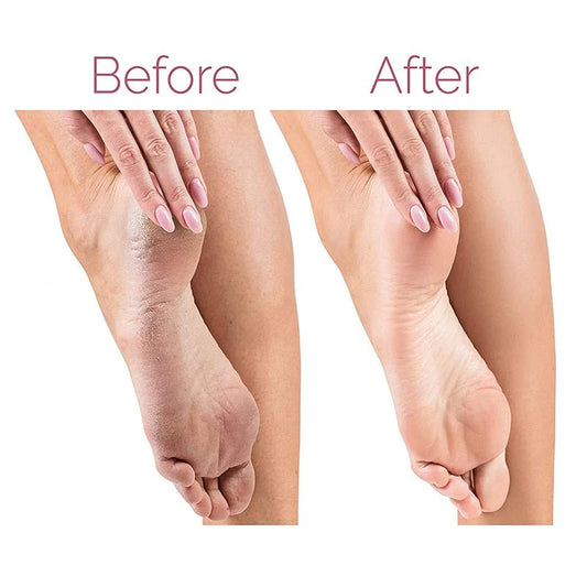 Electric Pedicure Foot File & Callus Remover