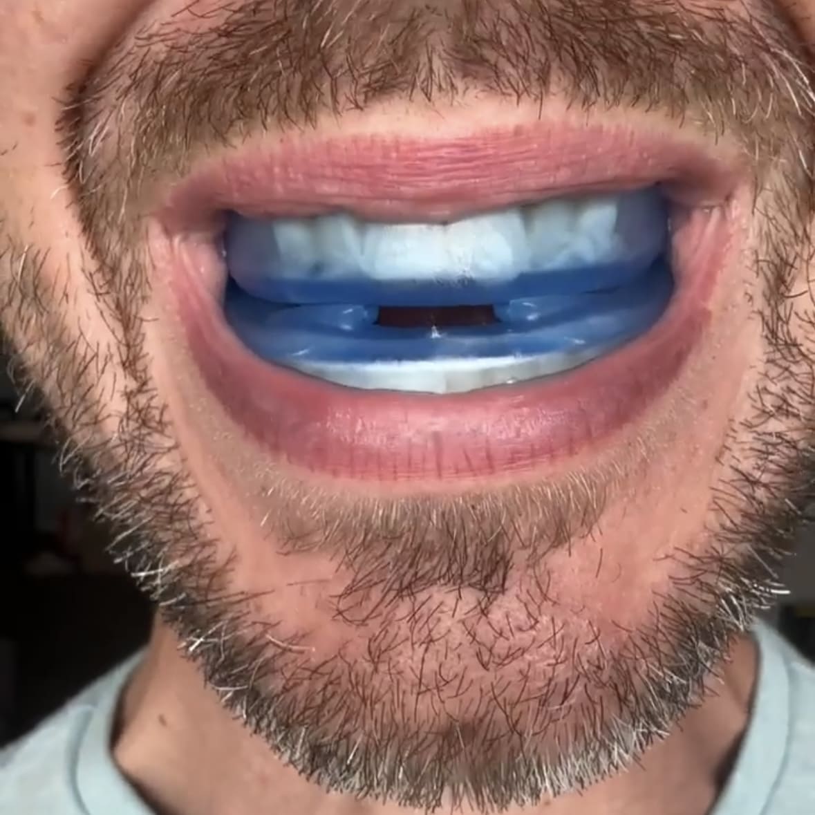 Anti Snore Mouth-Piece